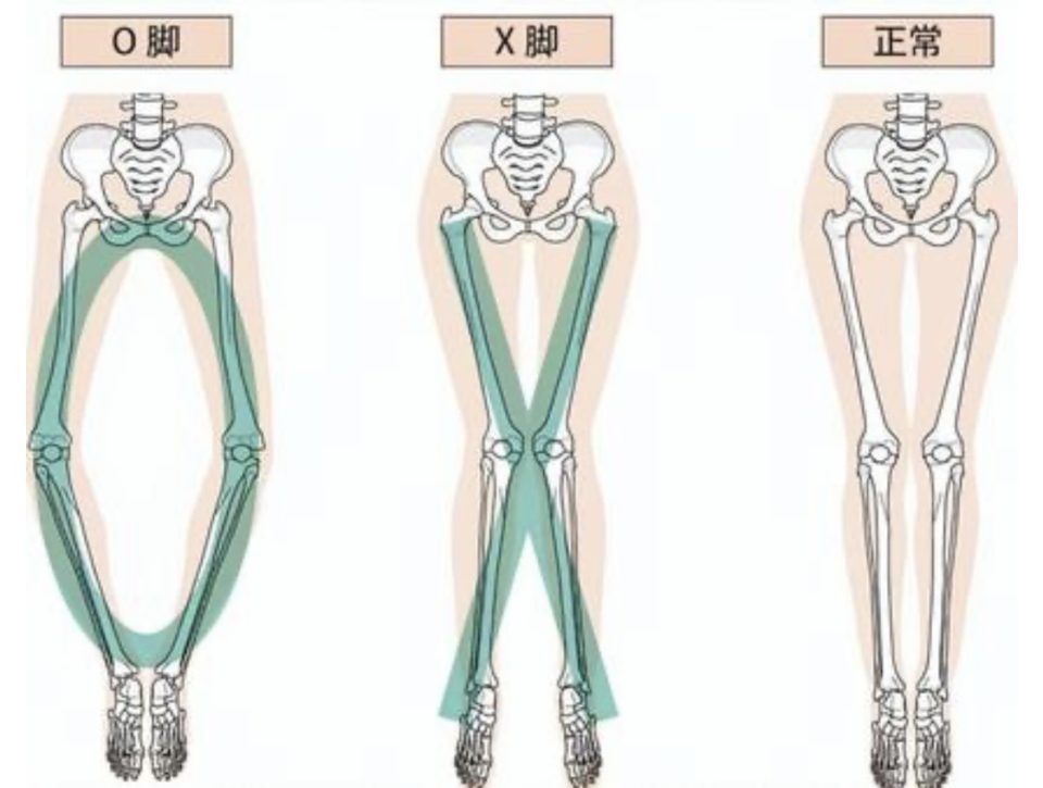 O脚をセルフケアで治そうとしている方へ