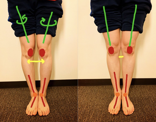脚から身長を伸ばす O脚を改善して身長を伸ばそう コラム O脚特集ページ 銀座 マッサージtotal Body Care 銀座整体院 お悩み解決します
